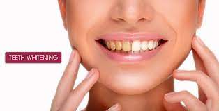Best Teeth Whitening Clinic